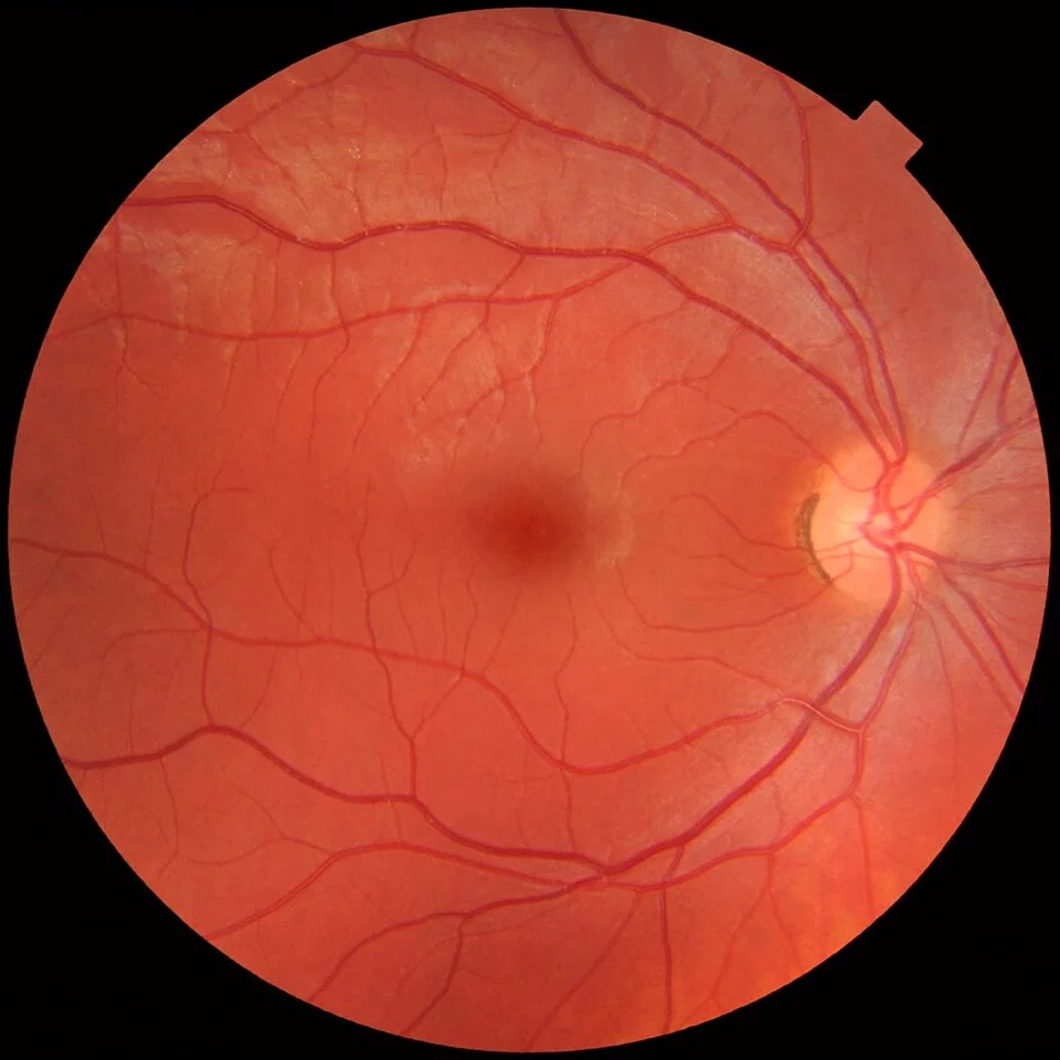 Fundus_photograph_of_normal_right_eye.webp