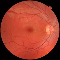 Fundus_photograph_of_normal_right_eye.webp