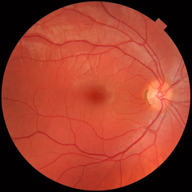 Fundus_photograph_of_normal_right_eye.webp