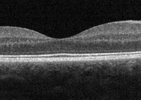 SD-OCT_Macula_Cross-Section.webp